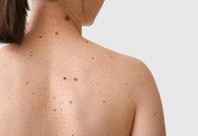 Εμβόλιο κατά του Μελανώματος: Η ιστορική καμπή στην παγκόσμια ιατρική