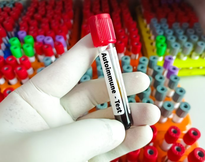 Blood,Sample,For,Autoimmune,Disease,Test.,Diagnosis,Of,Autoimmune,Disorder.